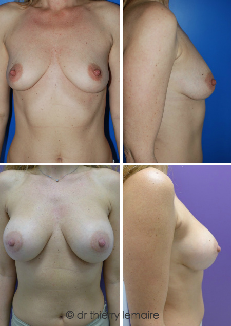 Augmentation mammaire naturelle avec des implants mammaires rondes de 300ml Profil Haut placées en arrière du muscle et de la glande (Dual Plane). Avant apres