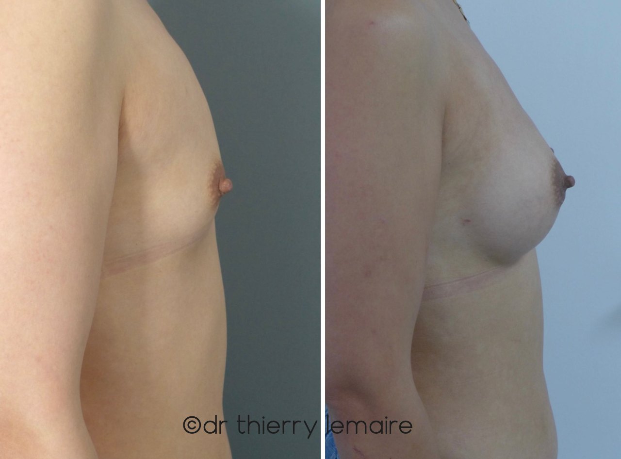 Photos Avant/Apres d'une augmentation mammaire naturelle obtenue avec des prothèses mammaires rondes de 265 ml profil haut