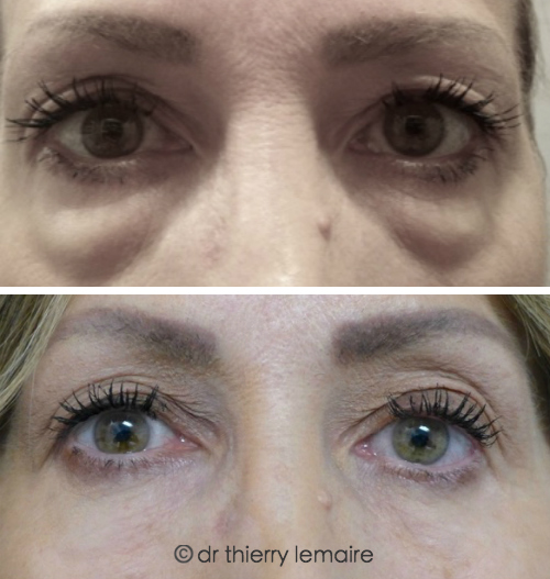 Blepharoplastie inferieure photo avant apres