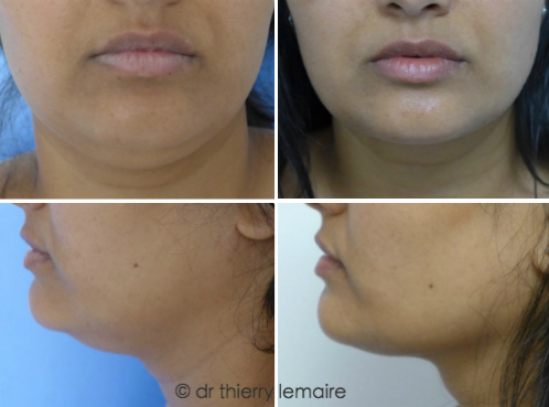 Avant apres (2 mois) - double menton / liposuccion du cou chez une jeune femme