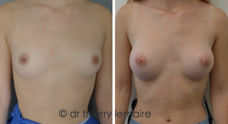 Augmentation mammaire naturelle par protheses à Paris