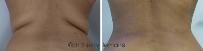 Lipoaspiration du dos, Chirurgie plastique du dos à Paris