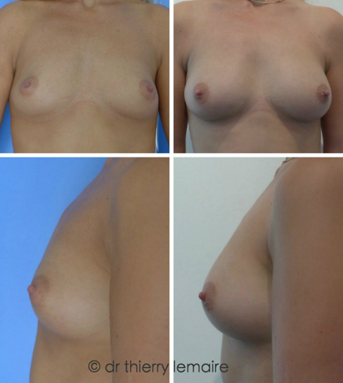 Lipofilling mammaire, graisse prélevée au niveau des hanches