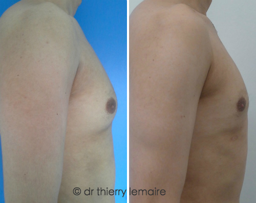 Gynecomastie : Photos avant-apres traitement d’une adipomastie, Docteur Lemaire, Paris. Avant Apres.