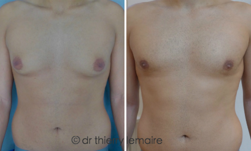 Adipomastie - gynecomastie par lipoaspiration - seins importantes chez un homme