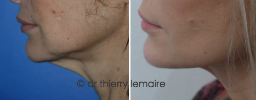 Rajeunissement visage et cou : lifting cervico-facial, avant apres