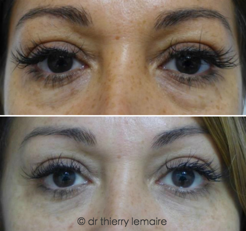 Blepharoplastie, Lipofilling chez une patiente chez une patiente présentant des cernes dus à des poches sous les yeux peu importantes. Avant apres.