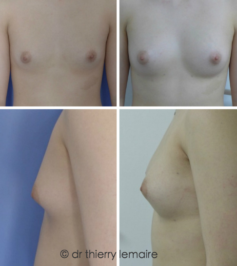 Augmentation de volume des seins par la graisse, Paris