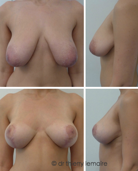 Les seins tombent : remonter les seins sans diminuer volume.