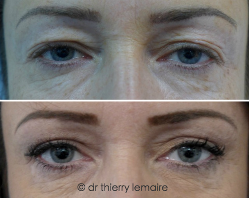 Photos avant-apres blepharoplastie superieure chez une femme de 39 ans.