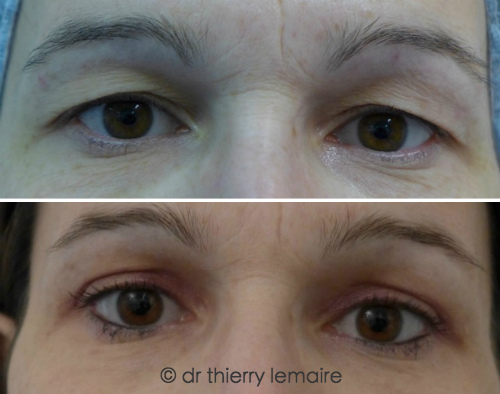 Chirurgie du regard, blepharoplastie superieure chez une femme de 40 ans. Avant apres.