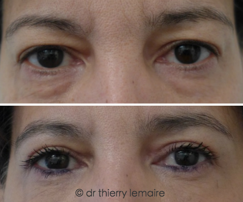 Photos avant/apres - blepharoplasties superieure et inferieure.