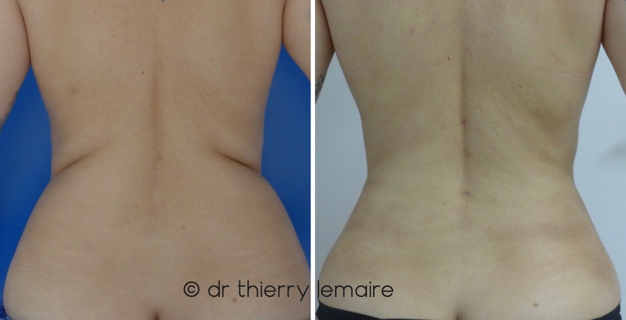 c'est quoi lipo Qu'est-ce que la liposuccion 360 ? main image 1