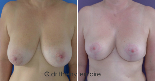 Photos avant apres une reduction mammaire modérée (230 g) de chaque côté selon la technique de la mammoplastie verticale
