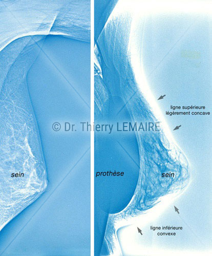 Radios avant/après une augmentation mammaire naturelle avec des prothèses rondes par Docteur Lemaire