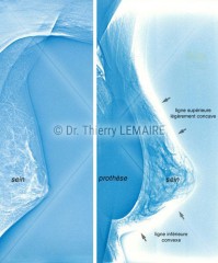 Photo prothèse mammaire, augmentation mammaire