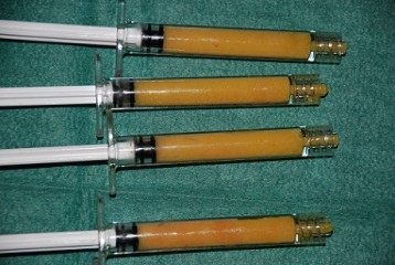 Seringues de 1ml remplies de graisse